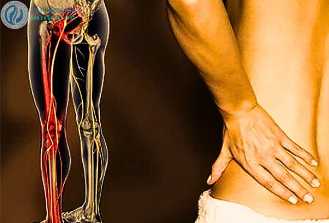 đau lưng lan xuống chân theo đường đi của dây thần kinh tọa