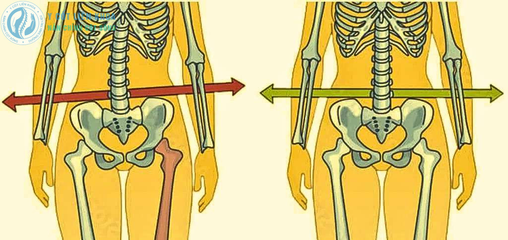 Hình ảnh xương lệch Chậu